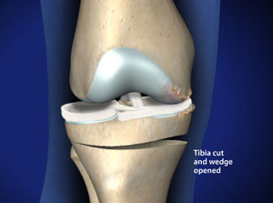 Остеотомия колена - коррекция оси колена