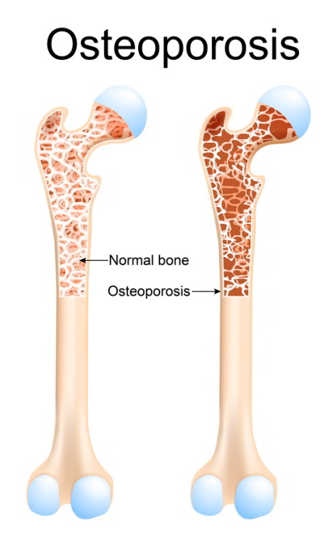 Остеопороз - это болезненная атрофия и снижение плотности костей скелетной мускулатуры. Сокращение содержания кальция в костных перекладинах значительно повышает вероятность переломов в тазобедренном суставе. © designua @ fotolia 