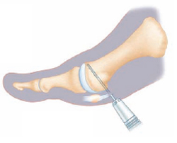 При минимально-инвазивной операции на Hallux valgus делается с помощью маленьких инструментов разрез в кости.© FH-Orthopedics При минимально-инвазивной операции на Hallux valgus делается с помощью маленьких инструментов разрез в кости.