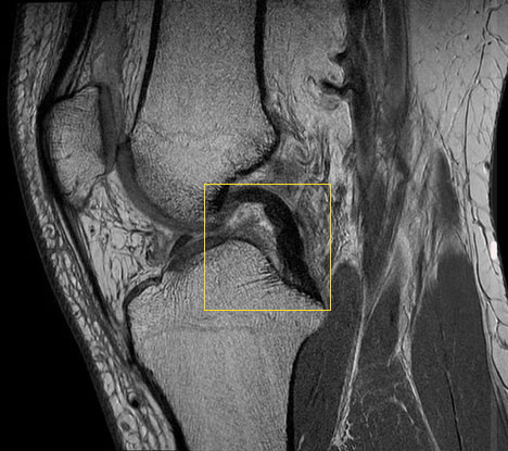 МРТ коленного сустава. Разрыв крестообразной связки