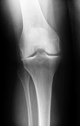 Рентген в положении стоя, вид спереди, показывает односторонний артроз колена: сужение межсуставной щели наблюдается лишь во внешней части сустава. Внутри  колена хрящ еще здоров. Частичный эндопротез коленного сустава по Repicci