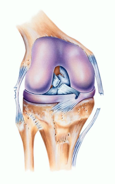 Хорошо видно повреждение передней крестообразной связки. При разрыве могут быть повреждены и боковые связки коленного сустава. © Istockphoto.com/MedicalArtInc