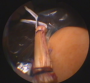 Снимок во время артроскопии коленного сустава: пересадка имплантата крестообразной связки © Gelenk-Klinik.de