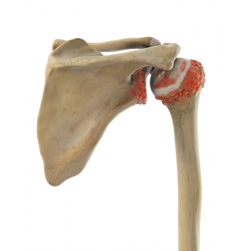 Для артроза плечевого сустава характерно постепенное изнашивание суставного хряща. Кости плеча больше не скользят по водянистой хрящевой поверхности, а сталкиваются друг с другом. На поверхностях суставов образуются костные шпоры (остеофиты), которые делают их шероховатыми и ускоряют процесс износа суставного хряща. 
