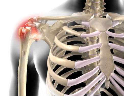 Разрыв вращательной манжеты - это повреждение сухожилия надостной мышцы, которая проходит под акромионом и охватывает головку плечевой кости сверху. Как правило, повреждается только часть широко сухожилия, что несмотря на сильную боль частично сохраняет функции вращательной манжеты. 