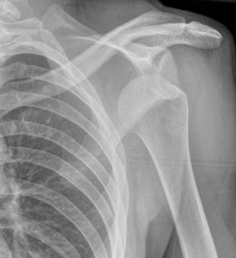 Рентген плечевого сустава после вывиха.  При нарушении конгруэнтности в плече головка плечевой кости выскакивает из капсулы сустава, после чего меняет свое положение и находиться далеко от акромиона. Сложившаяся ситуация приводит к повреждениям мягких тканей: Происходит разрыв хрящевидной суставной губы гленоидальной впадины плеча. Онемение в руке, а также стреляющие боли являются последствиями. Вывих должен быть вправлен врачом как можно быстрее. Затем необходимо провести детальную диагностику суставных структур, для того, чтобы исключить дегенеративные изменения сухожилий, связок и хрящевой ткани.  