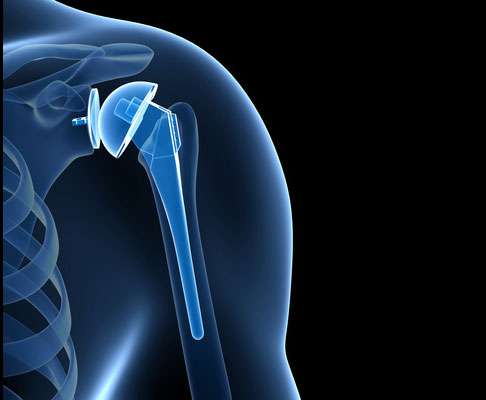 Протезы плечевых суставов при артрозе могут устранить боль в плече. © Viewmedica Протезы плечевых суставов при артрозе могут устранить боль в плече.