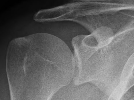 Рентген здорового плеча с достаточным пространством для головки плечевой кости под акромиальным отростком ключицы (акромион). Рентгенография показывает расположение костей по отношению друг к другу. Нормальное положение костей дает возможность предположить, что функции мышц и сухожилий не нарушены. 