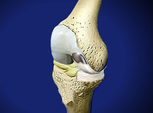 Частичный эндопротез коленного сустава по Repicci