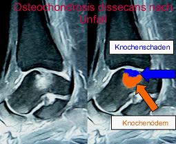 Остеохондроз голеностопного © Ortoped-klinik.com Остеохондроз голеностопного сустава